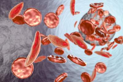 anemia falciforme