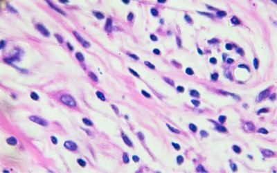 linfoma, ptld, terapia cellulare