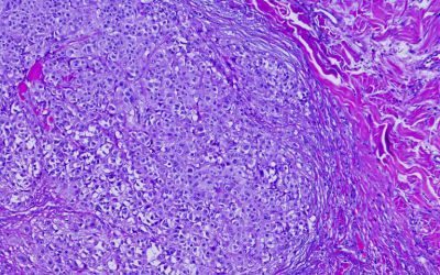 vaccino a mRNA, melanoma
