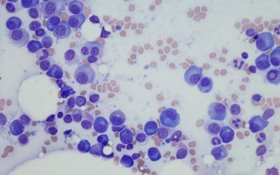 car-t, mieloma multipla