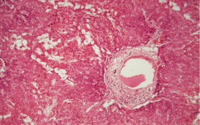 crispr, amiloidosi, somministrazioni